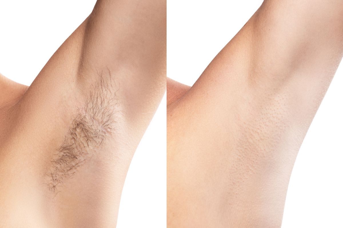 epilation-definitive-paris
